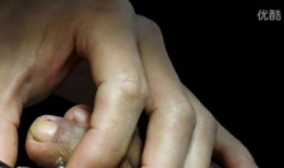 甲沟炎视频,视频解析病因、症状及治疗全攻略